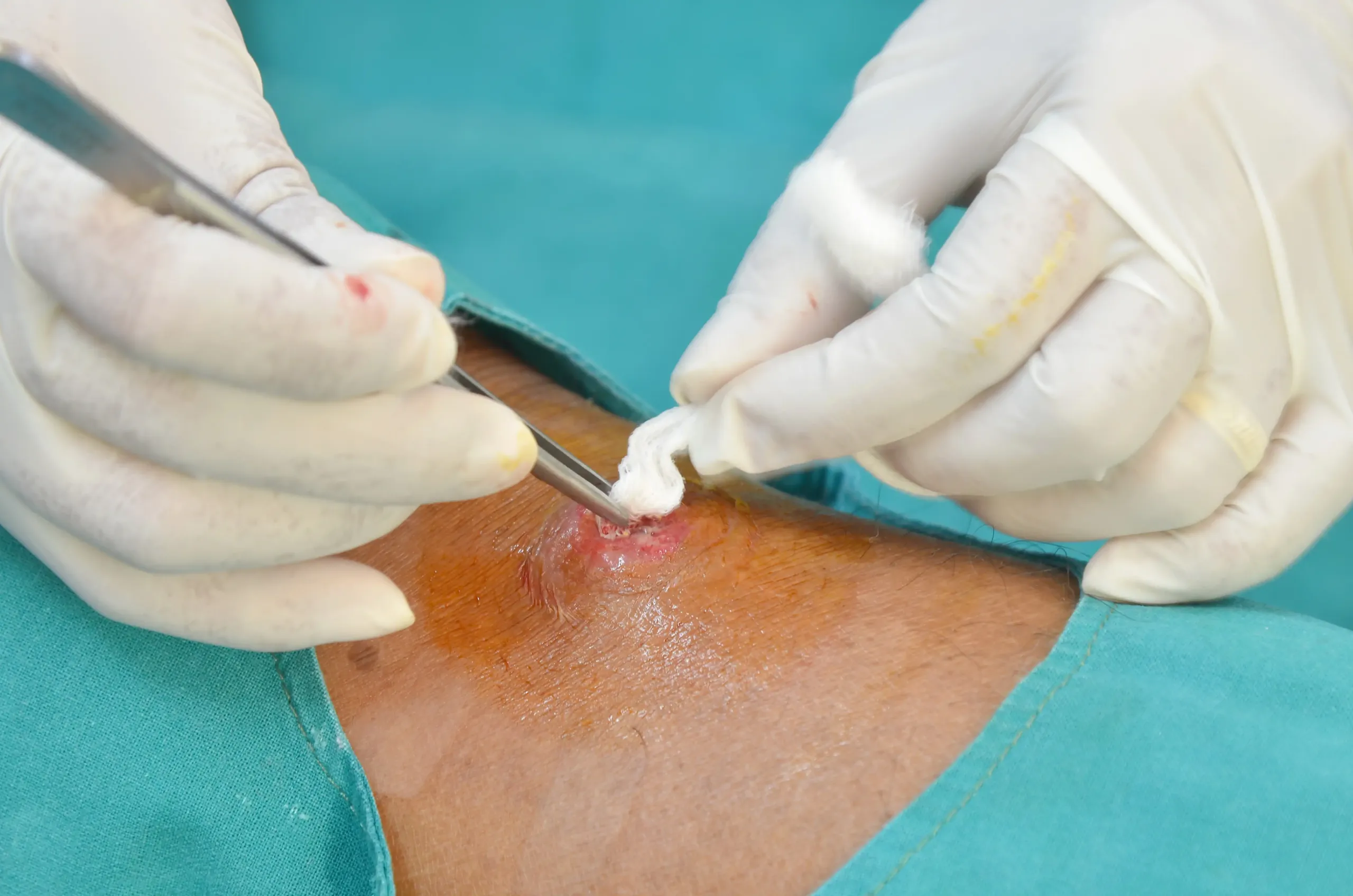 Is there a complete remediation for pilonidal cyst